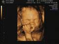 Baby Dillon 4D Ultrasound