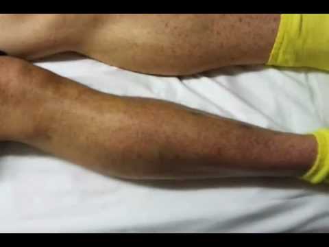 how to cure i t p blood disorder