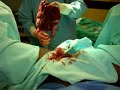 A PLACENTA