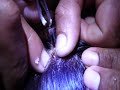 Removing a botfly from a girls head!