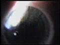 Brian's Lasik Brian's Lasik