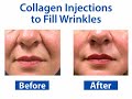 Wrinkle Fillers 101 Wrinkle Fillers 101
