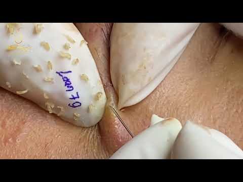 Stab and spear blackhead pulls (79) | Loan Nguyen