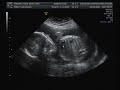 4D Ultrasound 24 weeks 2 days -- It's A BOY!!!!!
