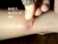 botfly larva in my ankle - days 38-39 update - final update!