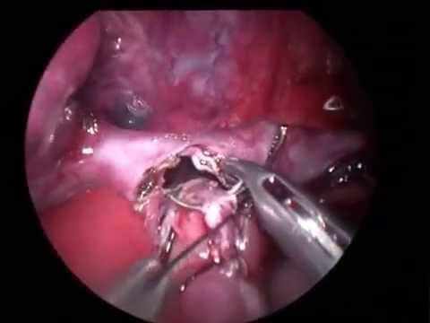 Achalasia Cardia | Pediatric Laparoscopy
