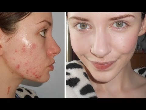 how to cure t zone acne