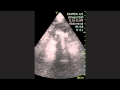 Nephrolithiasis Nephrolithiasis