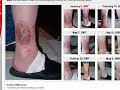 Shielding Skin Care Lotion Heals Chronic Eczema