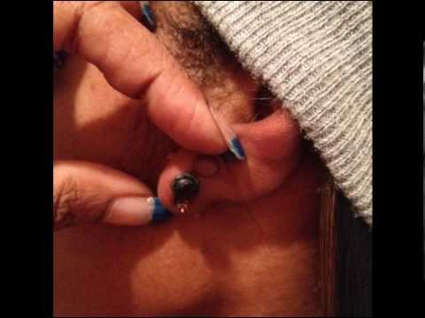 how to avoid keloids