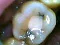 etime home endoscope - tooth