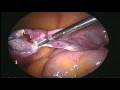 videos de LAVH Operation by LOTUS Torsional UltraSound