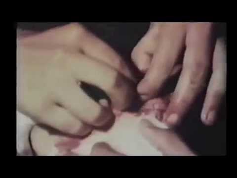 how to perform psychic surgery