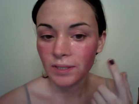 Video Diary for CO2 Fractional Laser for acne scarring (Day 1 of Recovery)