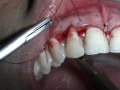 Cirurgia Paraendodontica (ABO) Parte 3