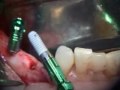 Implant Microsurgery Lower Right