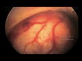 histeroscopia-de-mioma-intracavitario.html
