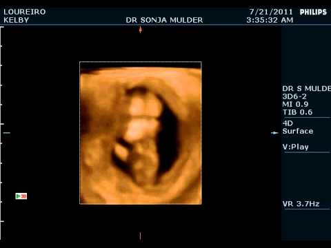 Baby Gordon-Louriero 2.AVI