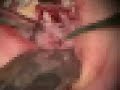 Periodontal Microsurgical Upper Cuspid Exposure