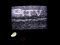 NTV Transatlantic Sporadic E