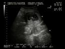 Primer Ecosonograma beb� Flores Cibri�n
