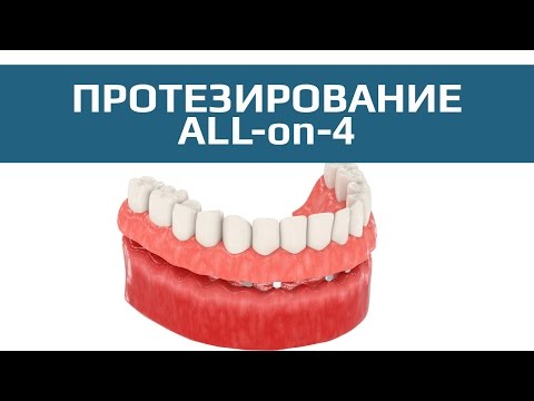 Комплексная имплантация All-on-4