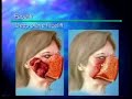 San Francisco Facelift & Necklift San Francisco Facelift & Necklift