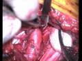 Neurosurgery: Thoracic outlet syndrome  by Dr. Bosnjak