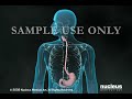 Endoscopia del tracto gastrointestinal superior