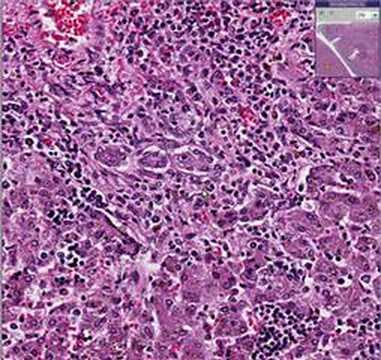 Histopathology Liver--Congenital ...