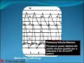 Part 4:pcc_reviewer Valvular Heart Disease (AR)