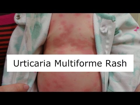 how to relieve erythema multiforme