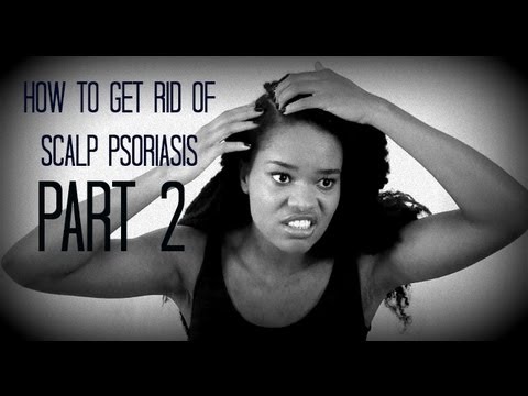 how to get rid psoriasis on the scalp