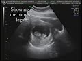 Baby Rosete-Dizon Ultrasound Video Baby Rosete-Dizon Ultrasound Video