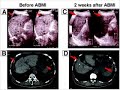 Stem Cell Therapy for Liver Failure