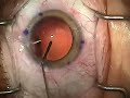 Modern Cataract Surgery: Alcon ReSTOR IOL with LRI
