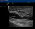 Phlebology Biosound Esaote MyLab 25 Tumescent Anesthesia