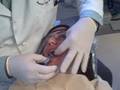 Braces off - removing Jacky's braces at Braces by Bergh by Dr. Brian H. Bergh, DDS, MS of Glendale, CA