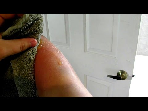 how to treat oozing blisters