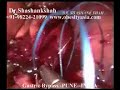 Lap Gastric Bypass for Morbid Obesity - Keyhole Laparoscopy Lap Gastric Bypass for Morbid Obesity - Keyhole Laparoscopy