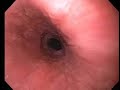 Upper endoscopy