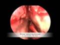 Endoscopic Approach for Pituitary Surgery