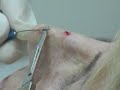 Shave Biopsy Technique