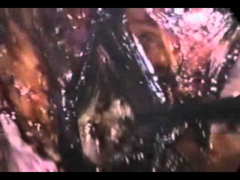 Laparoscopic Suture Rectopexy for Rectal Prolapse Without Constipation