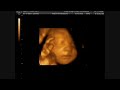 4D Ultrasound Video 29 Weeks 3 Days