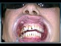 07 - Facetas em resina Cl�nica CIR (61) 3346-9001
