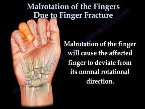 how to treat broken finger