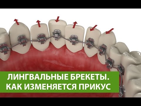 Лингвальные внутренние брекеты