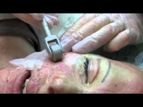 how to treat tca burn