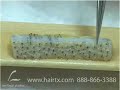 ASIAN HAIR TRANSPLANT GRAFT DISSECTION DALLAS TEXAS